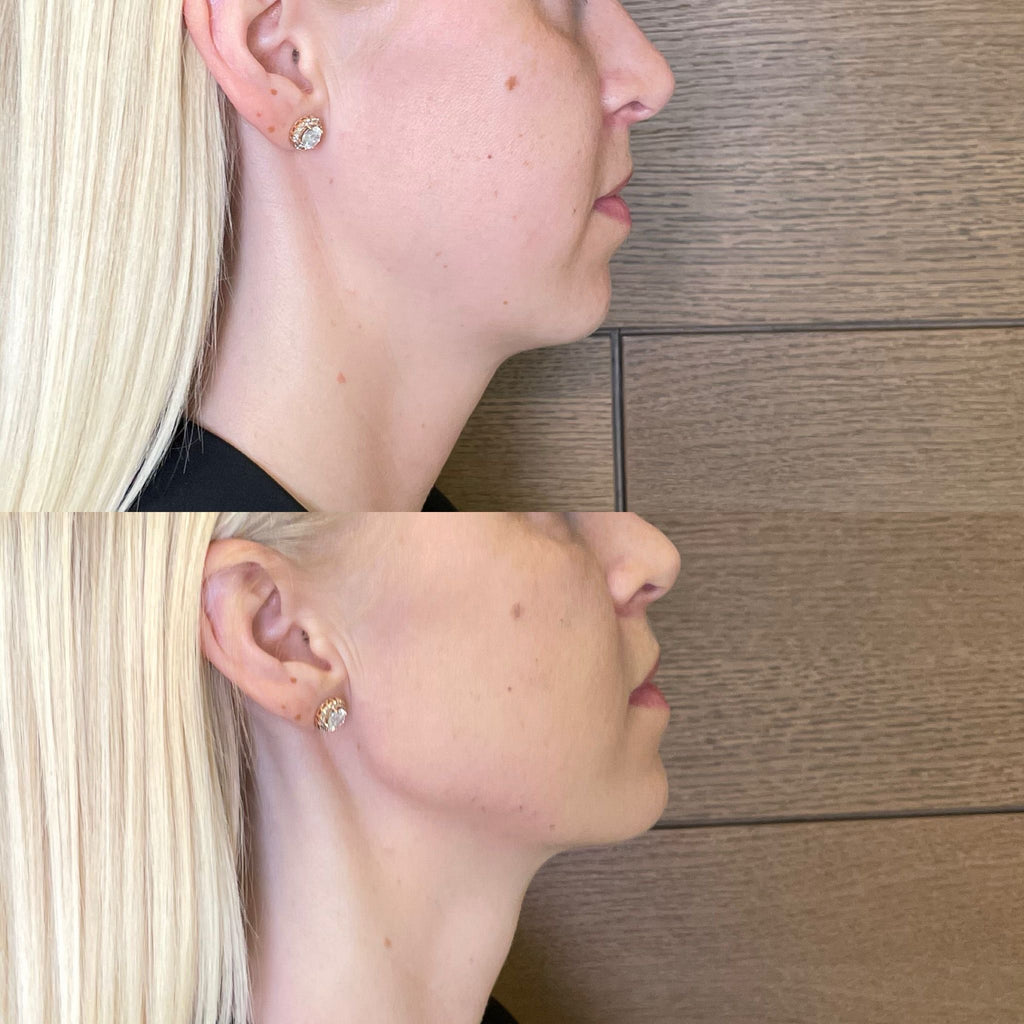 2 Effective Treatments to Eliminate Turkey Neck Fast