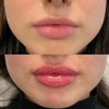 Can I Exercise After Getting Lip Fillers?