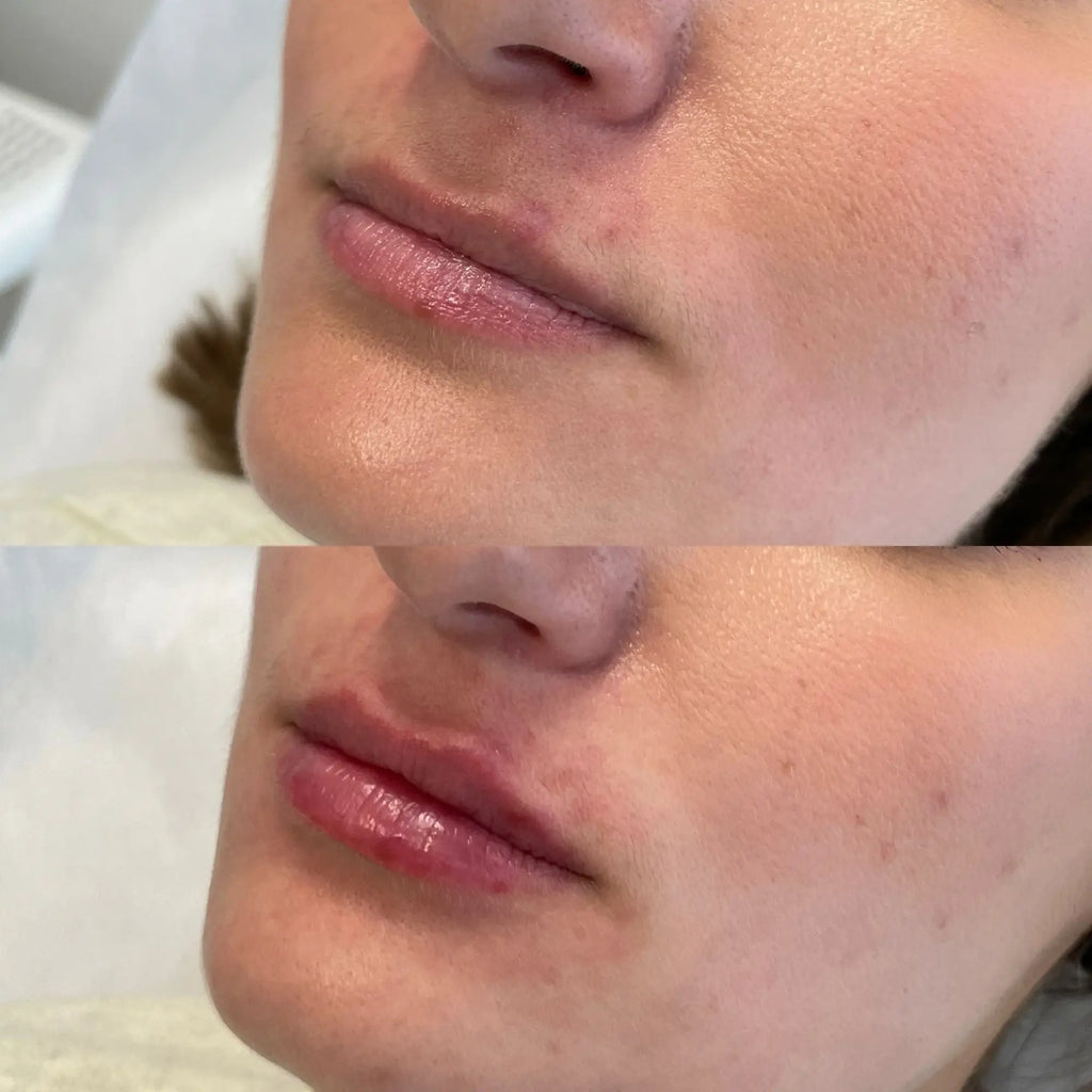 How Many Mls of Lip Filler Should I Get for the First Time?