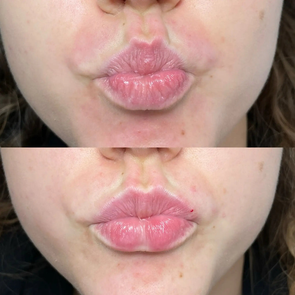 How Often Do You Need Lip Fillers Topped Up?