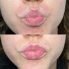 How Often Do You Need Lip Fillers Topped Up?