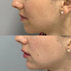 Microneedling Before And After