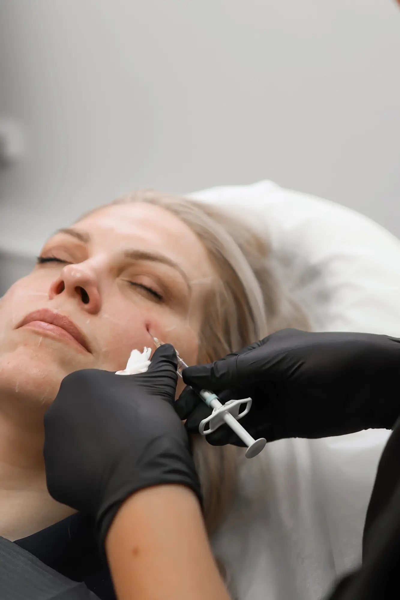 RF Microneedling: Benefits Process Results and Safety