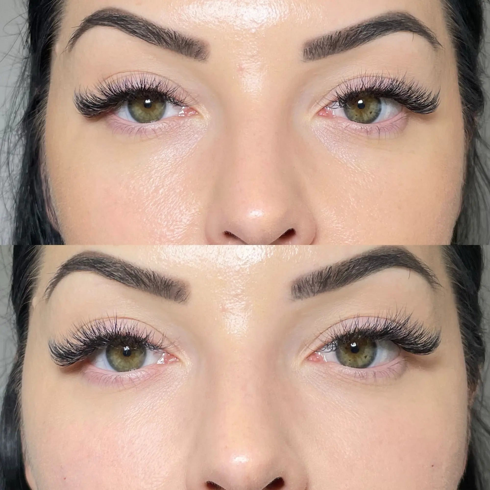 Tear Trough Filler Before And After