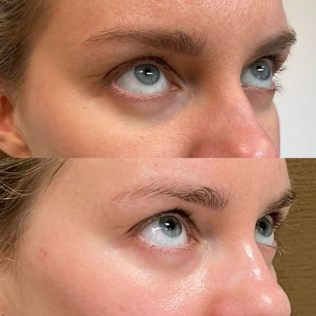 Under-Eye Wrinkle Solutions: Botox Fillers Ultherapy Peels
