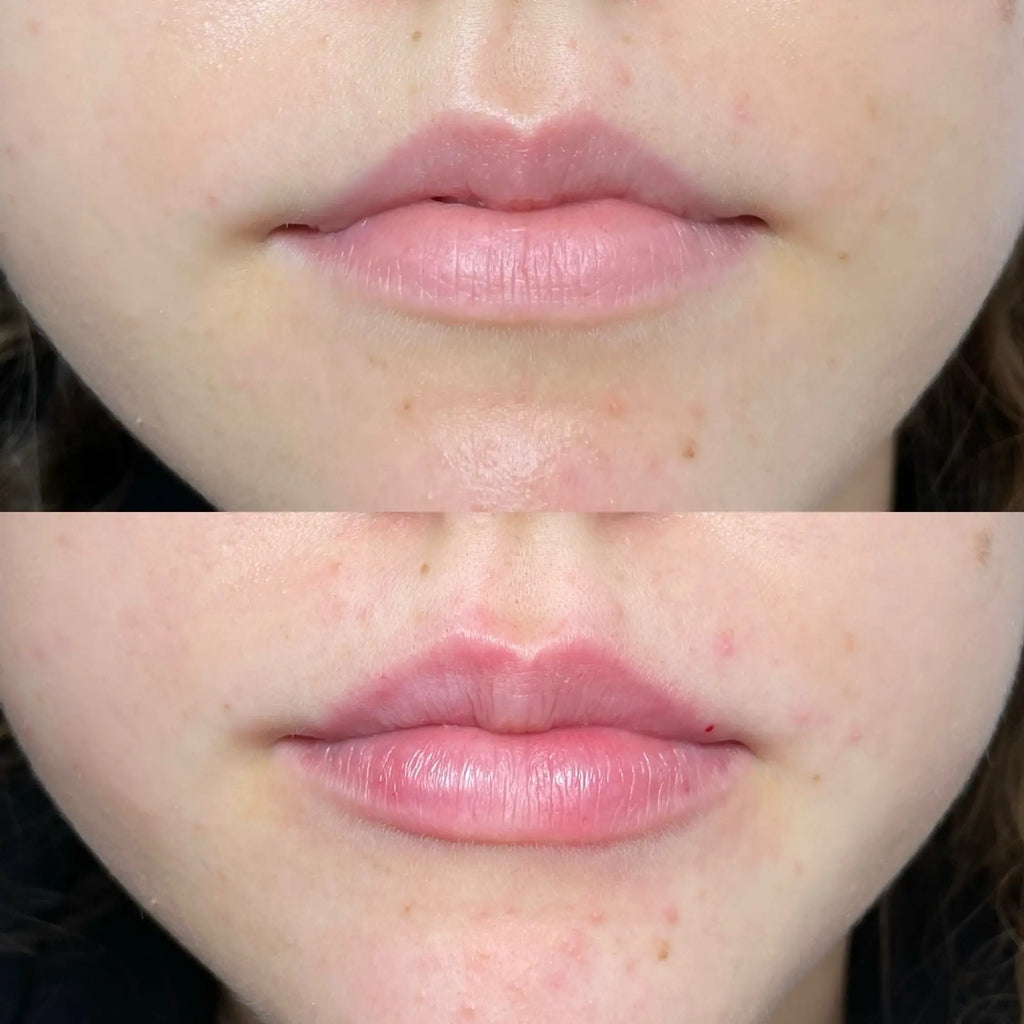 What Are The Do’s And Don’ts After Lip Fillers?
