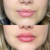 What Not To Eat and Drink after Getting Lip Fillers