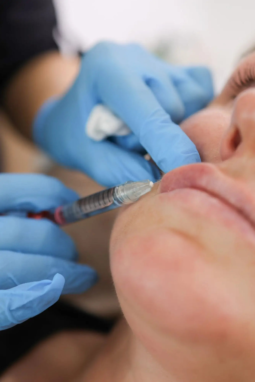 What Should You Not Do Before Lip Fillers?