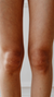 Knee fat treatment at It’s Me and You Clinic in London, Kingston upon Thames and Surrey – targeted CoolSculpting and fat reduction procedures to contour and slim the knee area.
