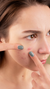 Acne Treatment in London & Kingston, Surrey – It's Me & You