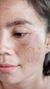 Hyperpigmentation Treatment in London & Kingston, Surrey – It's Me & You