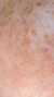 Pigmentation Treatment in London & Kingston, Surrey – It's Me & You