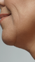 Facial volume loss and cheek volume treatment at It’s Me and You Clinic in London, Kingston upon Thames and Surrey – dermal fillers and collagen-boosting injectables to restore lost volume and contour the face.