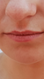 Thin lips fillers at It’s Me and You Clinic in London, Kingston upon Thames and Surrey – lip fillers to add volume, improve shape and enhance natural definition.