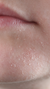 Dry skin treatment at It’s Me and You Clinic in London, Kingston upon Thames and Surrey – hydrating facials, skin boosters and moisturising therapies to restore moisture and improve skin texture.