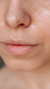 Dull skin treatment at It’s Me and You Clinic in London, Kingston upon Thames and Surrey – brightening facials, chemical peels and microneedling to revive tired, lacklustre skin and restore radiance.