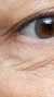 Under eye wrinkles treatment at It’s Me and You Clinic in Kingston upon Thames, Surrey and London – expert solutions including dermal fillers, microneedling, and skin tightening for smoother, younger-looking eyes.