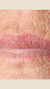 Lipstick lines treatment at It’s Me and You Clinic in London, Kingston upon Thames and Surrey – dermal fillers, skin boosters and microneedling to smooth vertical lip lines and rejuvenate the mouth area.