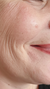Laughter Lines Treatment in London & Kingston, Surrey – It's Me & You