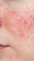Rosacea Treatment in London & Kingston, Surrey – It's Me & You