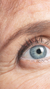 Crow's feet treatment at It’s Me and You Clinic in London, Kingston upon Thames and Surrey – anti-wrinkle injections, Botox and dermal fillers to smooth eye wrinkles and rejuvenate the outer eye area.