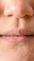 Thin and dry lips treatment at It’s Me and You Clinic in London, Kingston upon Thames and Surrey – lip fillers and skin boosters for lip volume, hydration and smooth texture.