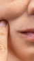 Nose to mouth lines treatment at It’s Me and You Clinic in London, Kingston upon Thames and Surrey – nasolabial fold fillers and anti-wrinkle injections to smooth deep facial lines.