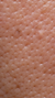 Large pores treatment at It’s Me and You Clinic in London, Kingston upon Thames and Surrey – advanced skincare solutions including microneedling, resurfacing peels and laser therapy to minimise visible pores and refine skin.