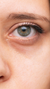 Dark circles under eyes treatment at It’s Me and You Clinic in London, Kingston upon Thames and Surrey – tear trough fillers, Ultherapy and microneedling to brighten under-eye area and reduce discoloration.
