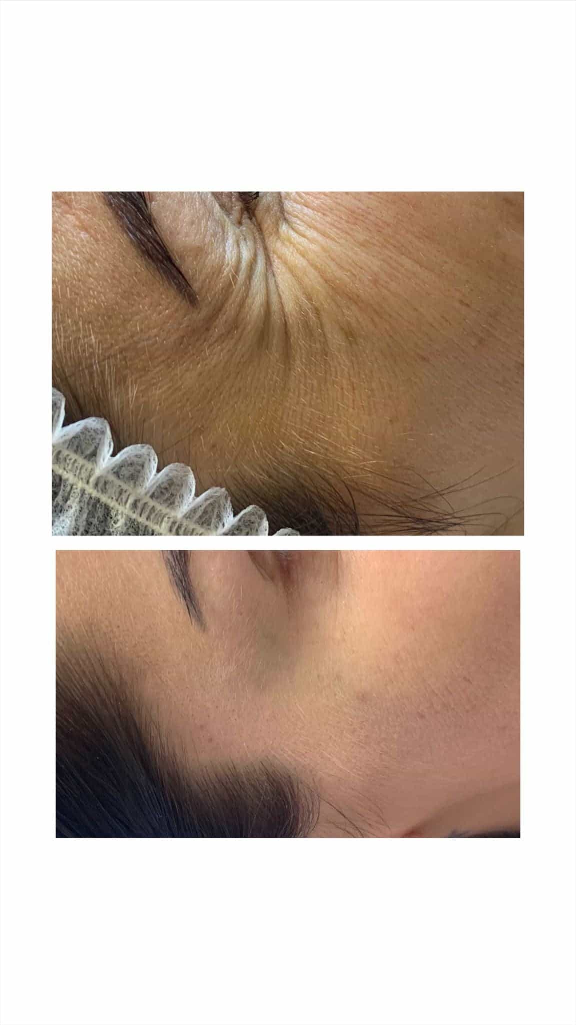 Crow’s feet treatment at It’s Me and You Clinic in London, Kingston upon Thames and Surrey – Botox injections to smooth fine lines around the eyes.