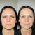Nasal flare treatment at It’s Me and You Clinic in Kingston upon Thames, Surrey – natural nose reshaping with Botox injections to reduce nostril flare and refine nose appearance.