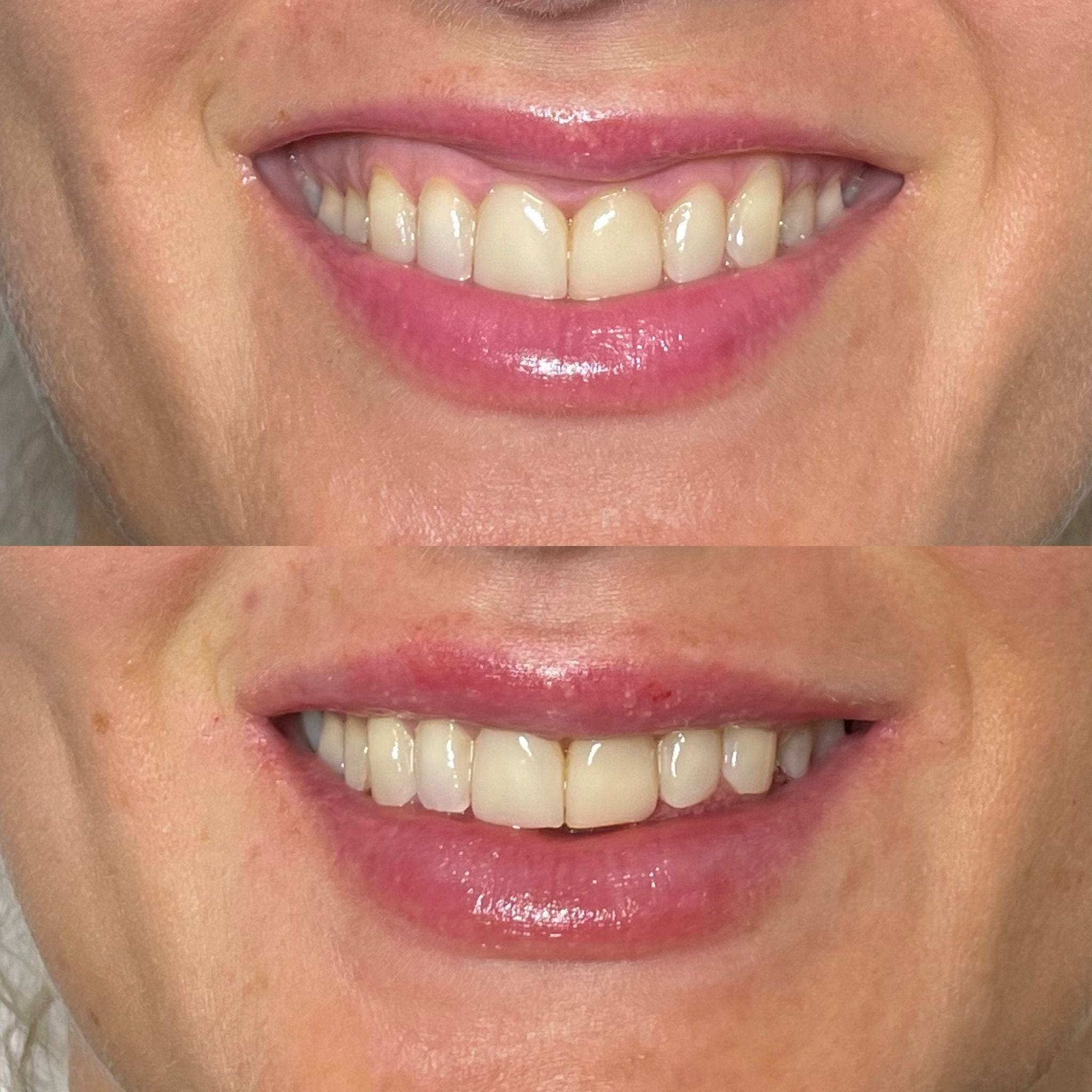 Lip Filler Injections in Kingston, Surrey, London