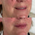 Lip and mouth filler treatment for smokers lines at It’s Me and You Clinic in Kingston upon Thames, Surrey and London – targeted dermal fillers to reduce fine lines and restore youthful lips.