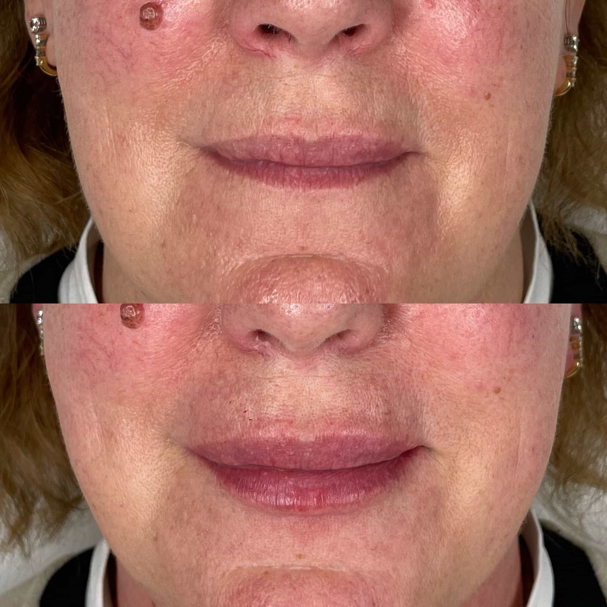 Smokers lines treatment with lip and mouth fillers at It’s Me and You Clinic in Kingston upon Thames, Surrey and London – non-surgical solution to soften wrinkles around the mouth.