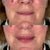 Smokers lines treatment with lip and mouth fillers at It’s Me and You Clinic in Kingston upon Thames, Surrey and London – non-surgical solution to soften wrinkles around the mouth.