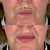 Smokers Lines Lip & Mouth Fillers - Kingston Upon Thames, Surrey, London – It's Me & You