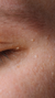 Milia Treatment in London & Kingston, Surrey – It's Me & You