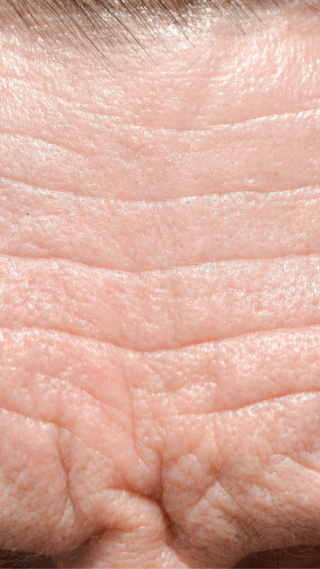 Forehead Wrinkles | Best Treatment for Forehead Wrinkles in London & K – It's Me & You