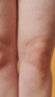 Knee Fat Treatment in London & Kingston, Surrey – It's Me & You