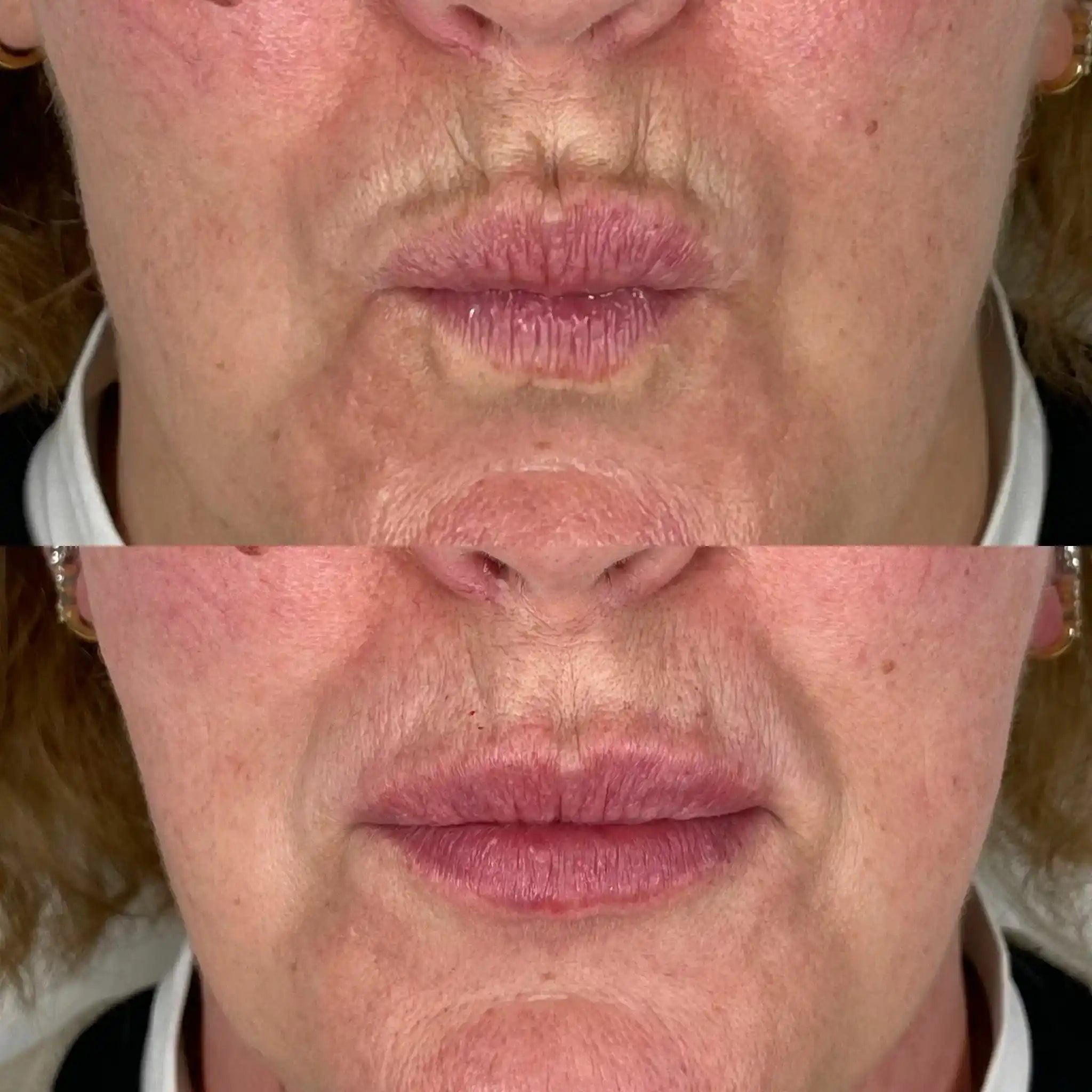 Dermal filler injections for smokers lines at It’s Me and You Clinic in Kingston upon Thames, Surrey and London – enhancing lip contour and smoothing perioral wrinkles.