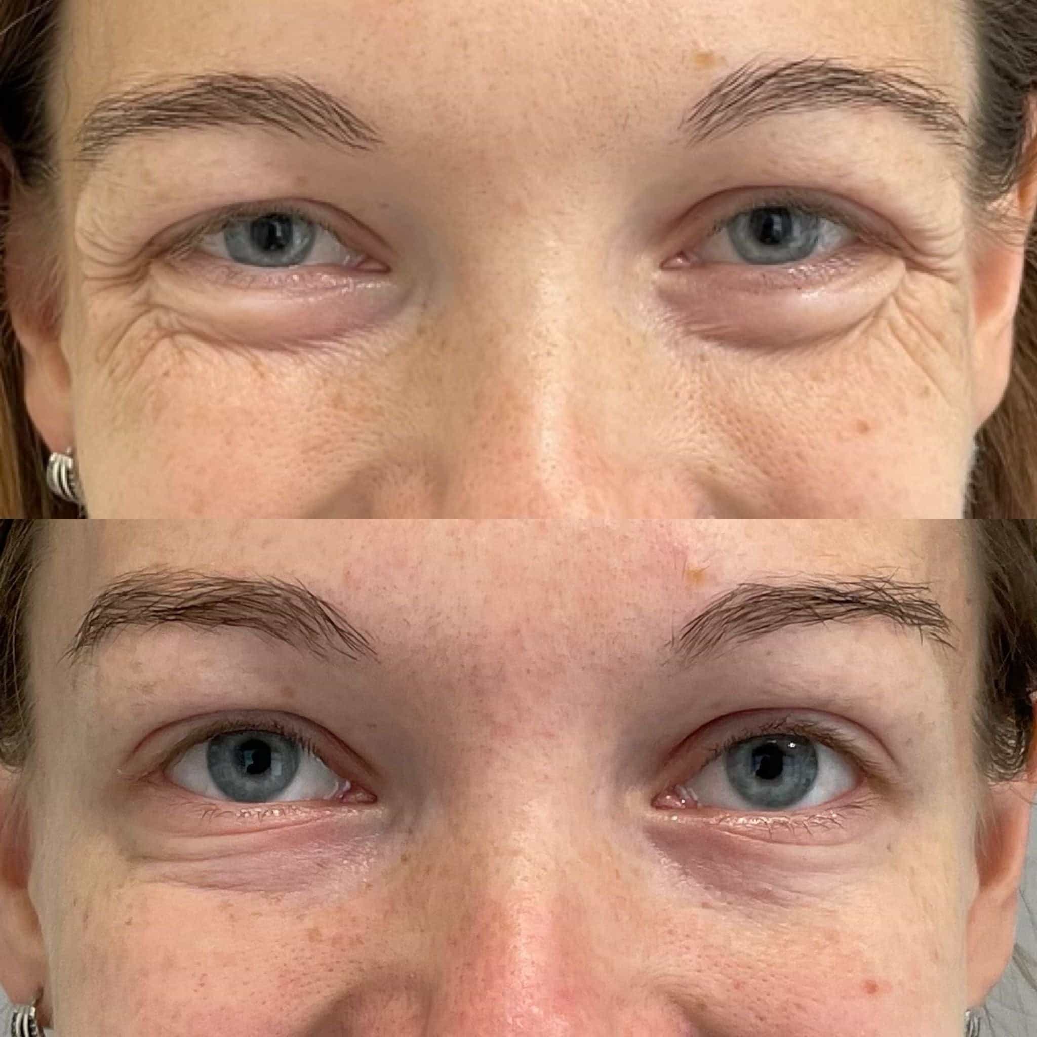 Anti-wrinkle treatment for crow’s feet at It’s Me and You Clinic in London, Kingston upon Thames and Surrey – effective injectable therapies to reduce eye wrinkles.