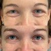Anti-wrinkle treatment for crow’s feet at It’s Me and You Clinic in London, Kingston upon Thames and Surrey – effective injectable therapies to reduce eye wrinkles.