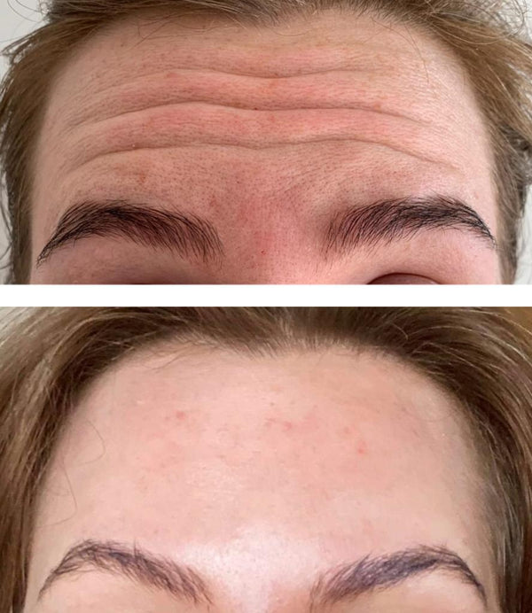 Brow Lift in Surbiton - Consultation