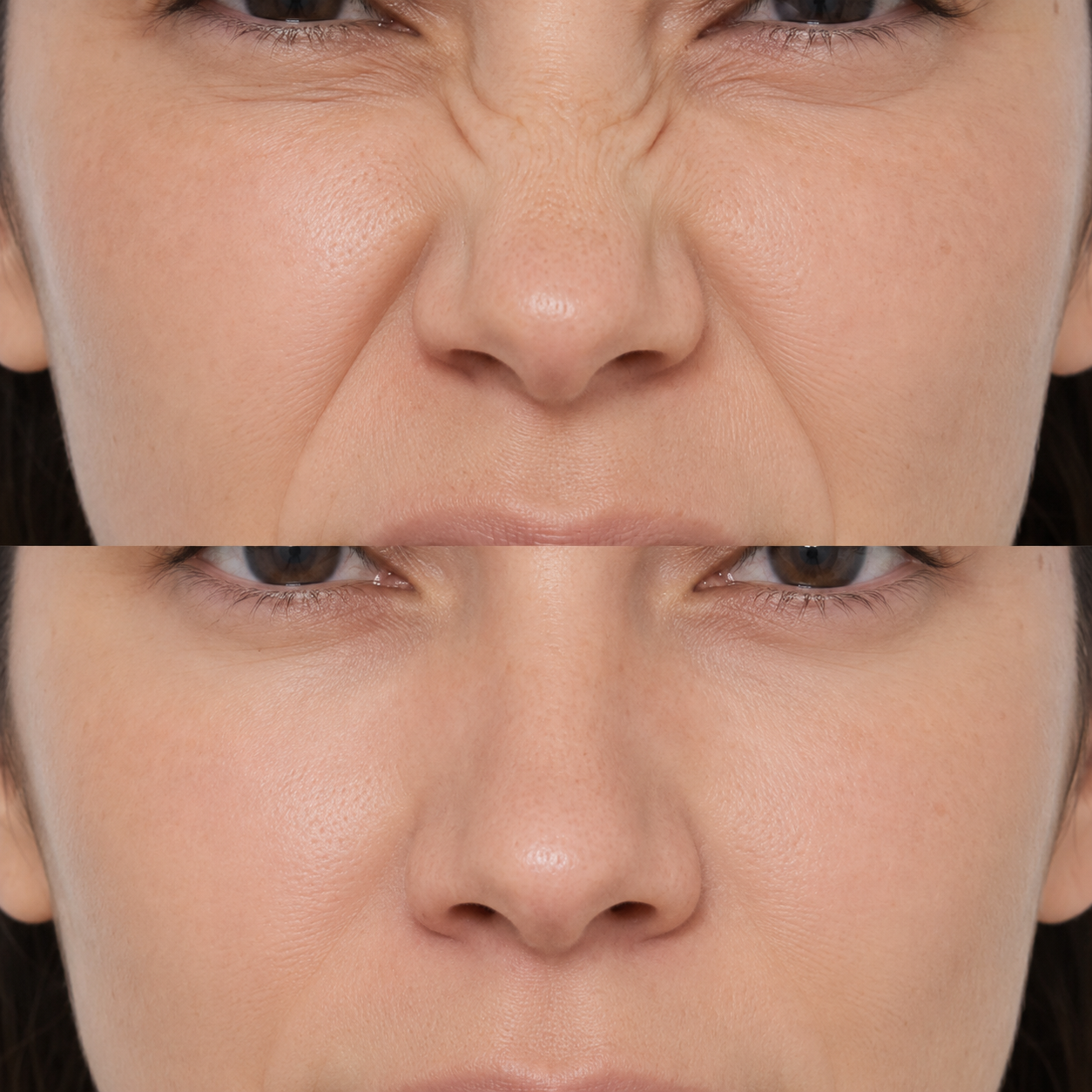 Before and after bunny lines Botox treatment showing softened wrinkles at the sides of the nose