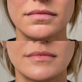 Before and after chin crease filler showing a softened labiomental fold and smoother contour between the lower lip and chin.