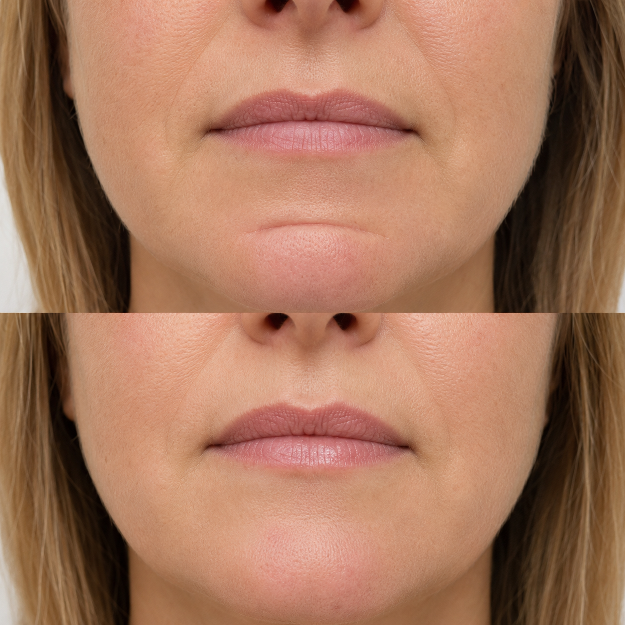 Before and after chin crease treatment showing a softened labiomental fold and smoother lower chin contour.