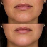 Before and after chin crease treatment showing a visibly softened labiomental fold and smoother lower face contour.