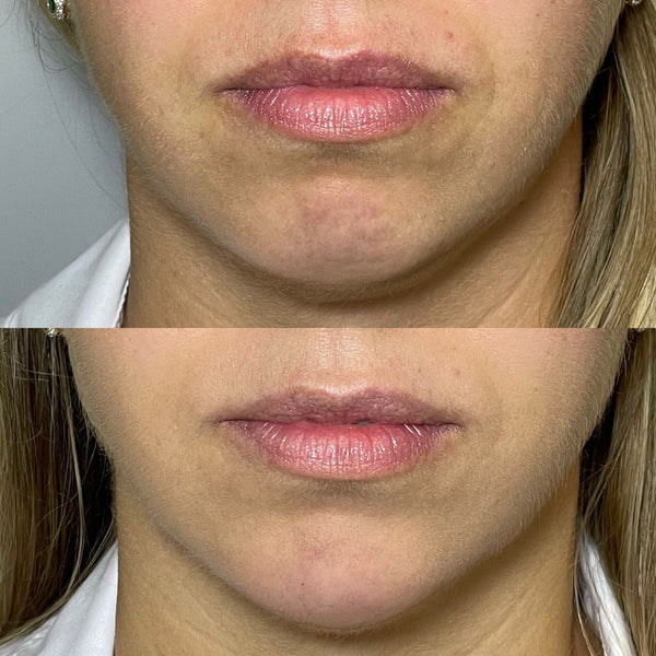 Jawline and chin enhancement results Surrey – Before and after