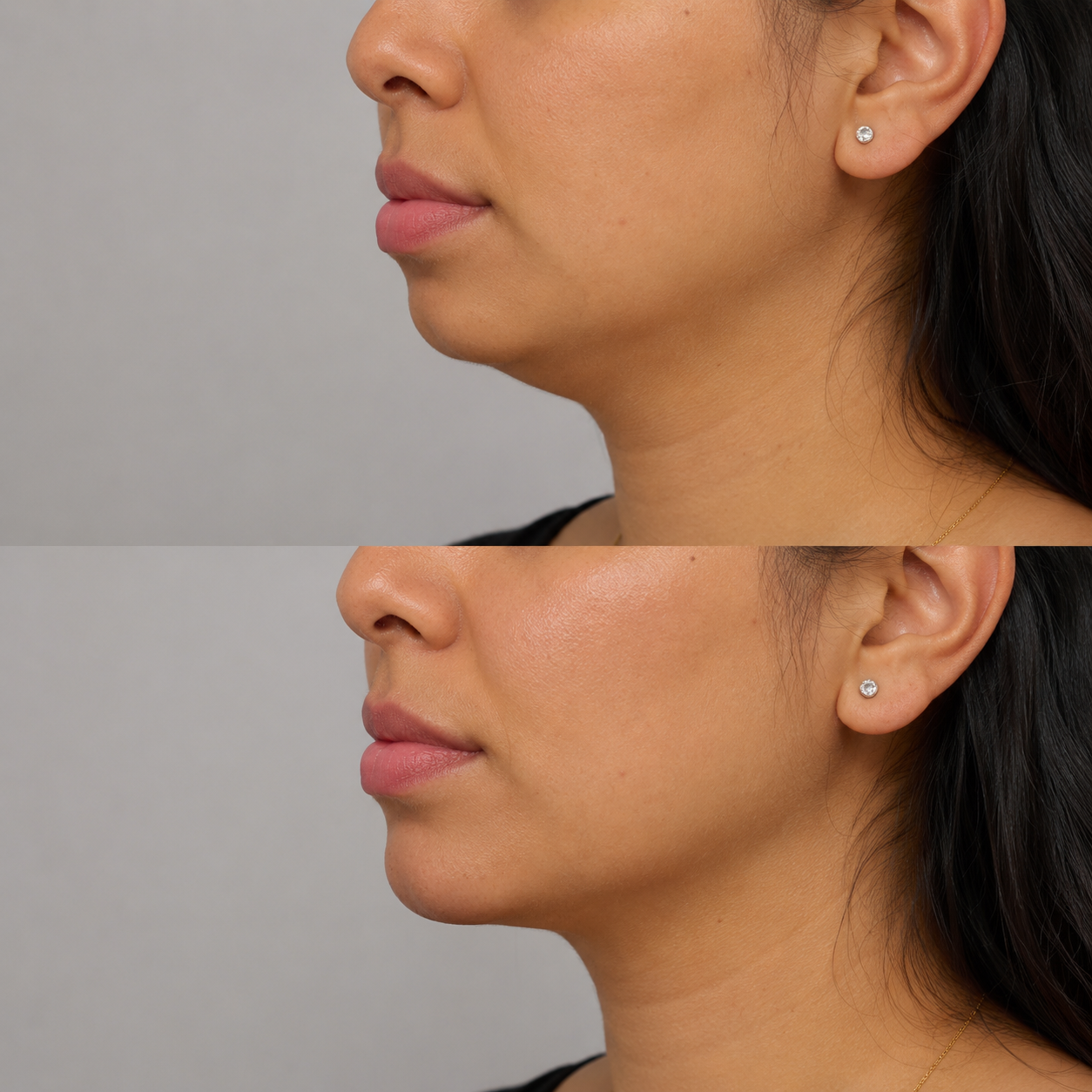 Before and after chin filler treatment showing a clearly recessed chin improved with natural projection and a more defined lower face profile.