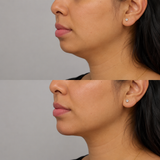 Before and after chin filler treatment showing a clearly recessed chin improved with natural projection and a more defined lower face profile.